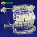 SELL 12567 Life Size Transparent Dental mit Zahnimplantat